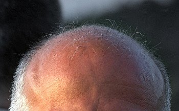 Another reason for us to stop air pollution: Hair Loss