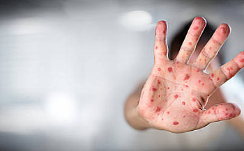 New findings show importance of measles vaccination 