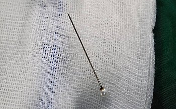 Scarf pin removed from 17-year-old’s lung at IGMH